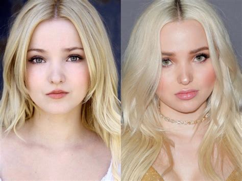 dove camerons plastic surgery|Dove Cameron's NEW FACE .